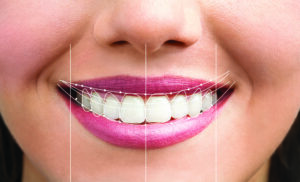 Diseño de sonrisa en clinica dental
