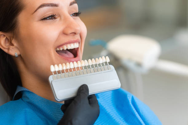 Blanqueamiento en clinica dental