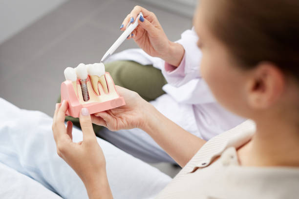 Implantes en clinica dental