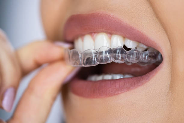 Invasilign en clinica dental